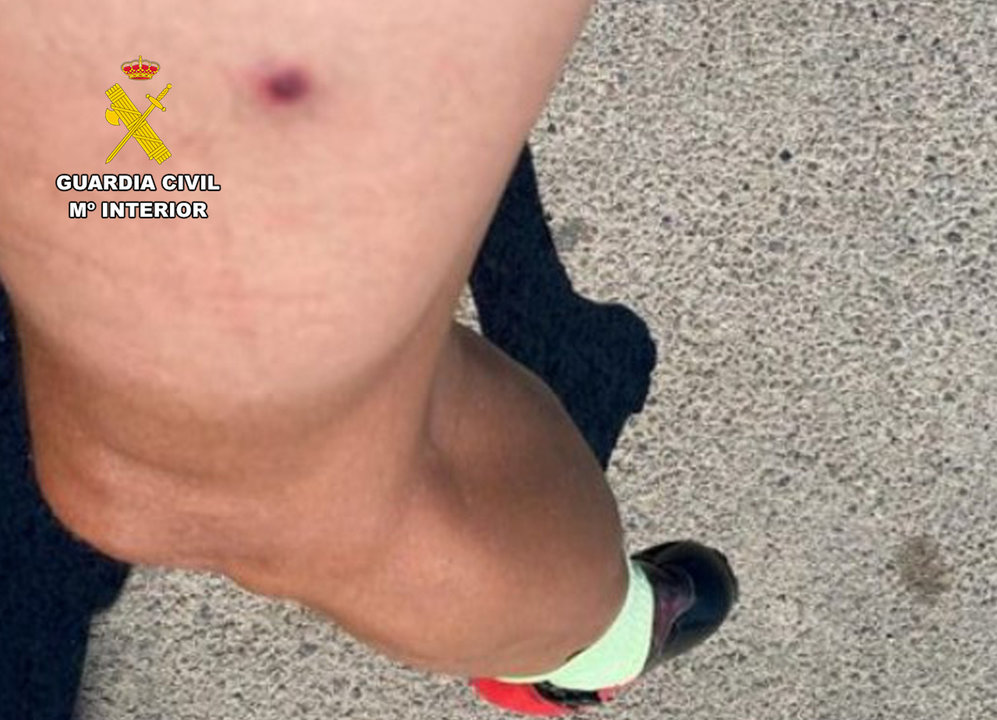 Imagen de una de las heridas de un ciclista (Foto: Guardia Civil)